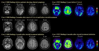 Amyloid and tau PET in cerebral amyloid angiopathy-related inflammation two case reports and literature review